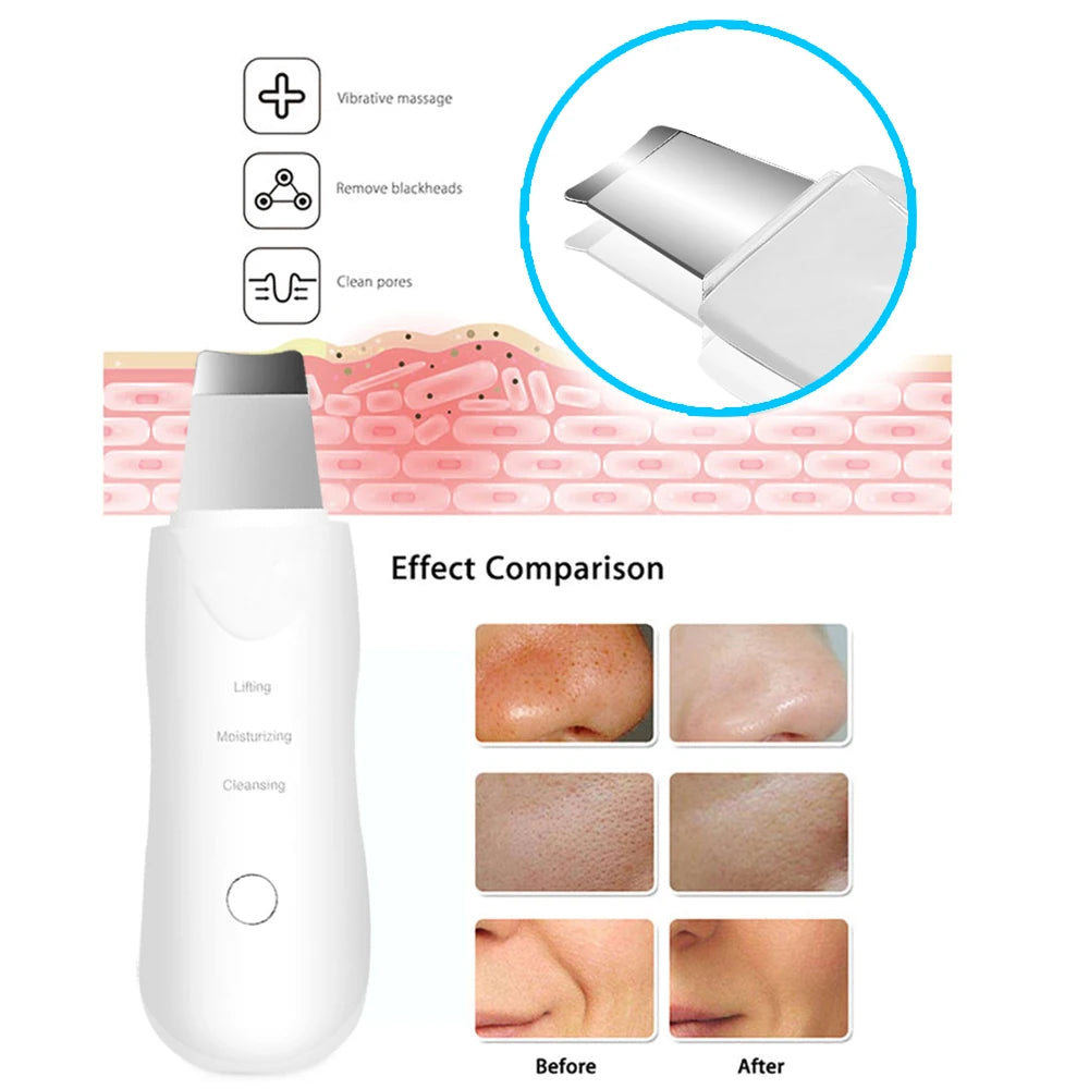 Lunylla Ultrasonic Skin Scrubber